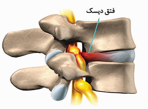 ديسك ستون فقرات